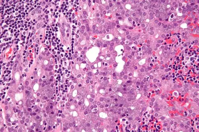 Acinic Cell Carcinoma : 腺泡细胞癌