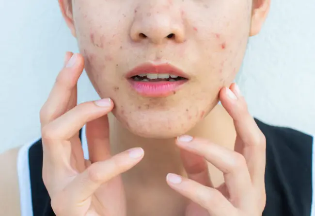 Acne-Associated Arthritis : 痤疮相关关节炎