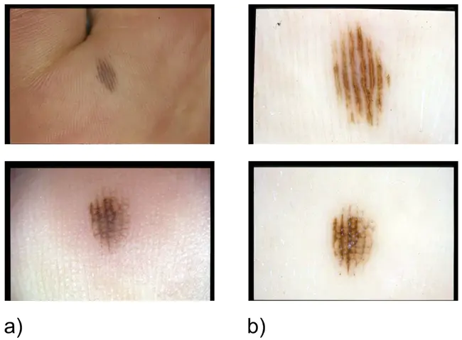 Acral Melanoma : 肢端黑素瘤