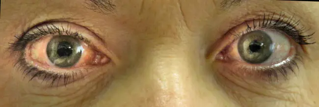 Acute Allergic Conjunctivitis : 急性过敏性结膜炎