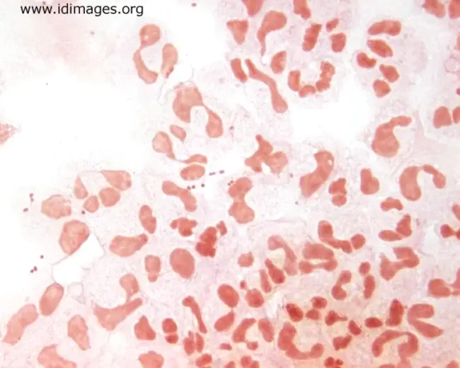 Acute Bacterial Meningitis : 急性细菌性脑膜炎