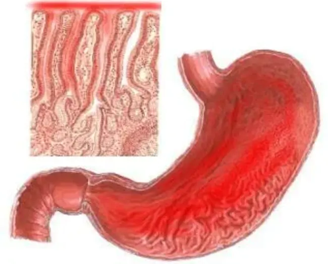 Acute Bacterial Nephritis : 急性细菌性肾炎