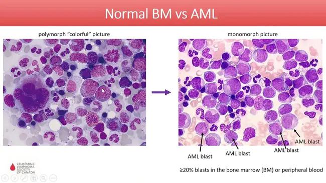 Acute Eosinophilic Pneumonia : 急性嗜酸性肺炎