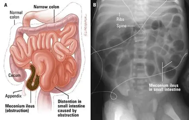 Acute Ileus : 急性Ileus