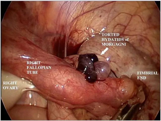 Acute Mesenteric Infarction : 急性肠系膜梗塞