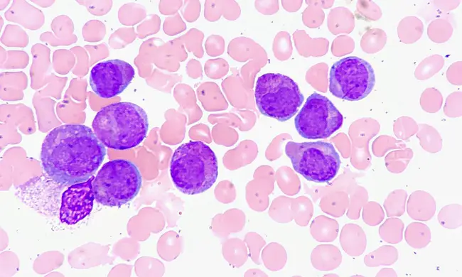 Acute Miliary Tuberculosis : 急性粟粒性肺结核