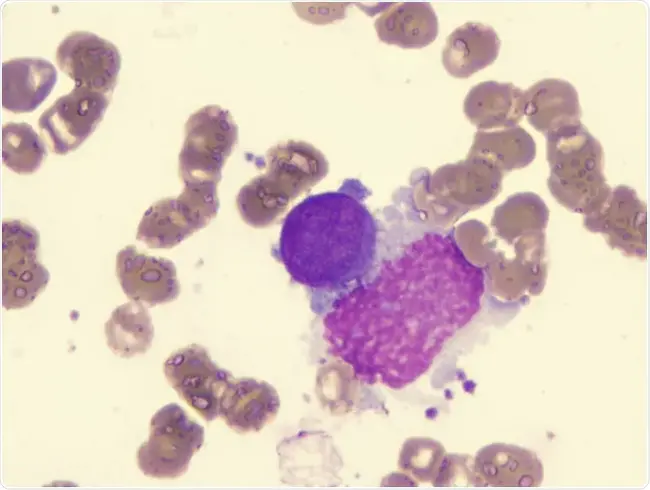 Acute Myelofibrosis : 急性骨髓纤维化