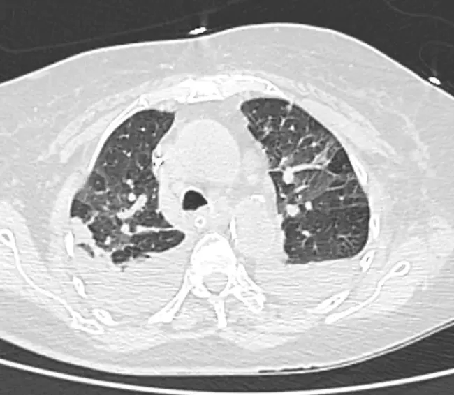 Acute Edematous Pancreatitis : 急性水肿性胰腺炎