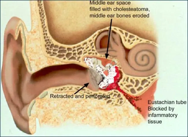 Acute Suppurative Cholangitis : 急性化脓性胆管炎