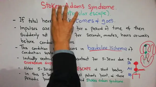 Adams-Stokes syndrome : 亚当斯-斯托克斯综合征