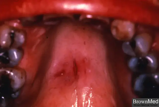 Adenoid Cystic Carcinoma : 腺样囊性癌