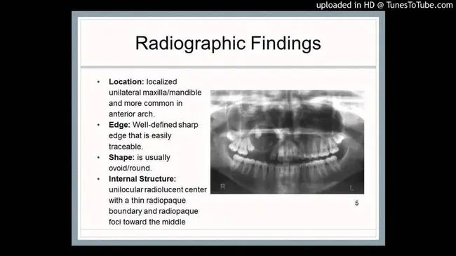 Adenomatoid Odontogenic Tumour : 腺瘤性牙源性肿瘤