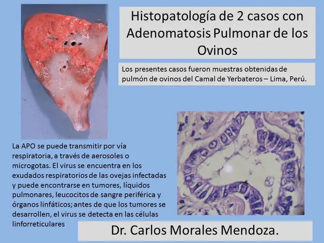 Adenomatosis of Colon and Rectum : 结肠直肠腺瘤