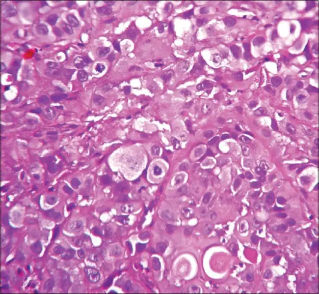 Adeno-Squamous carcinoma : 腺鳞癌