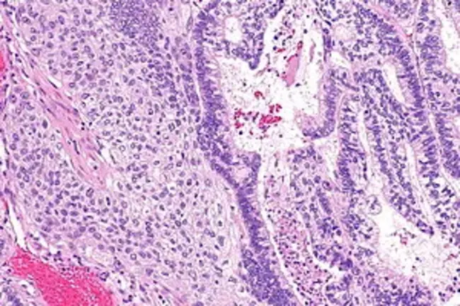 adenosquamous cell carcinoma : 腺鳞癌