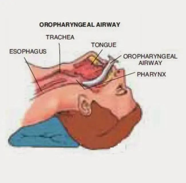 Airway Inflammation : 气道炎症