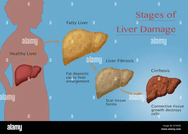 Alcoholic Cirrhosis : 酒精性肝硬化