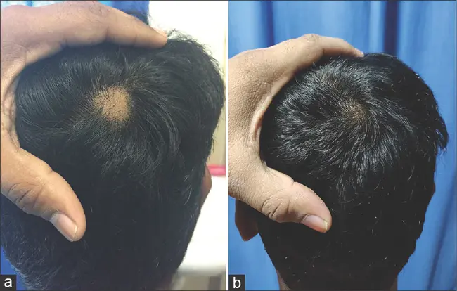 Alopecia Totalis : 总脱发