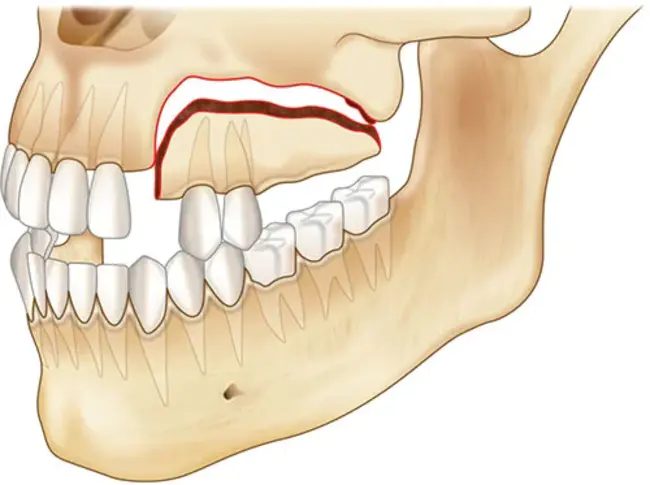 Alveolar Bone Grafting : 牙槽骨移植