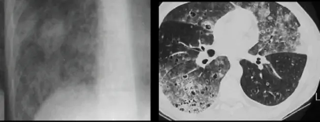 Alveolar Cell Carcinoma : 肺泡细胞癌