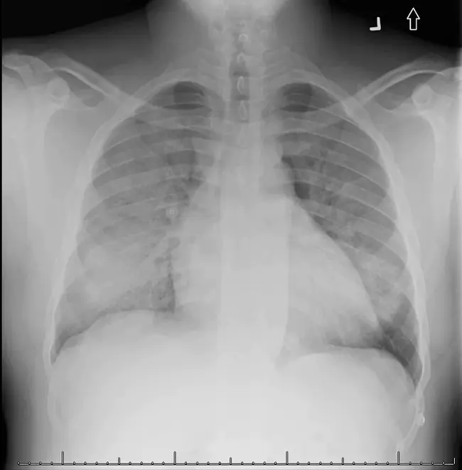 Alveolar Interstitial : 肺泡间质