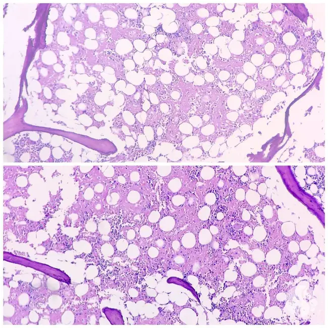 Amyloid Light chain : 淀粉样轻链