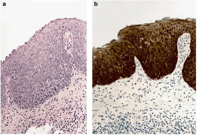 Anal Epithelial Neoplasia : 肛门上皮瘤形成