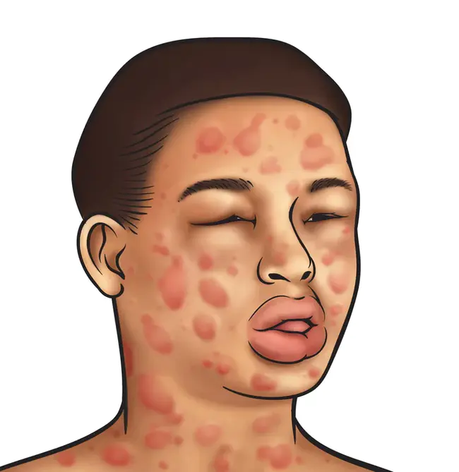 Anaphylaxis : 过敏反应