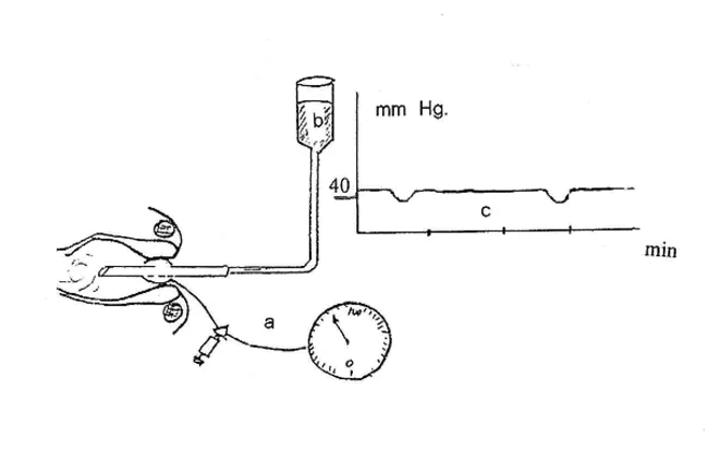 Anastomotic Bursting Pressure : 吻合口破裂压力