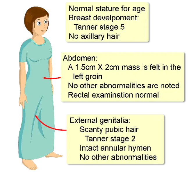 Androgen-Insensitivity Syndrome : 雄激素不敏感综合征