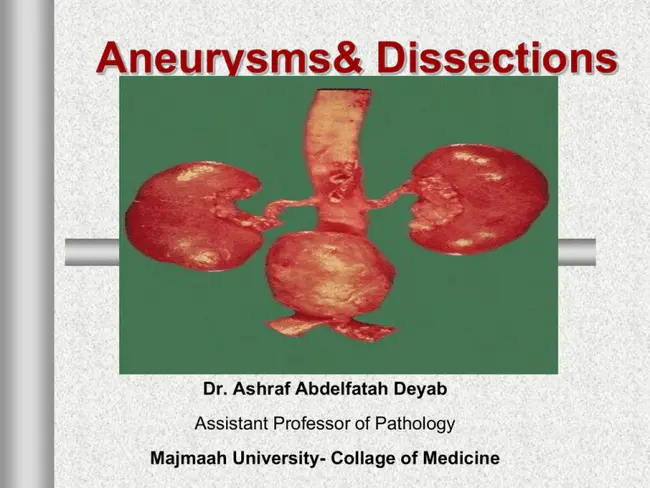 Aneurysm of Atrial Septum : 房间隔动脉瘤