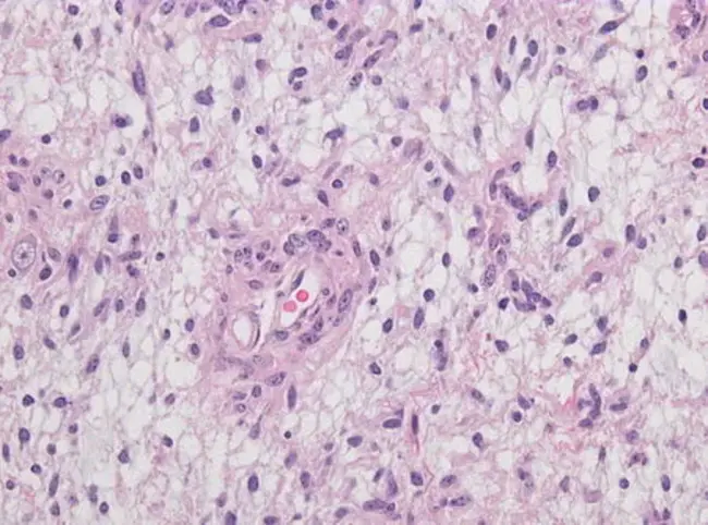 Angiocentric Immunoproliferative Lesion : 血管中心免疫增生性病变