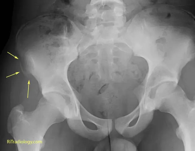 Anterior Cervical Discectomy : 颈椎前路椎间盘切除术