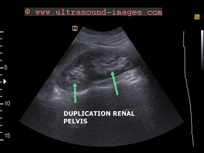 Anterior Kidney : 前肾