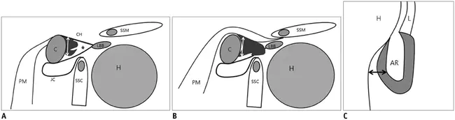 Anterior Subcapsular Cataract : 前囊下白内障