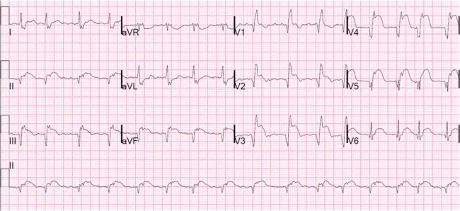 anteroseptal : 前旁的