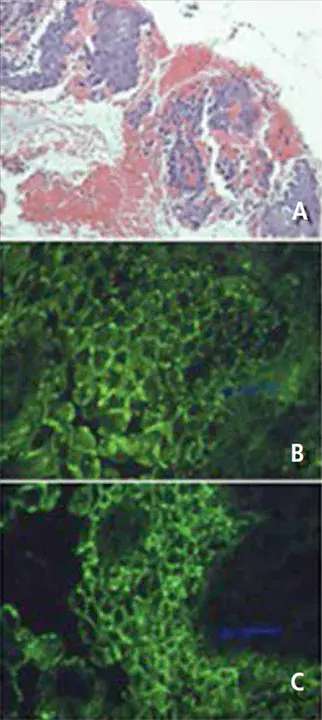 Anti-Malignin Antibody in Serum : 血清中抗马利金蛋白抗体