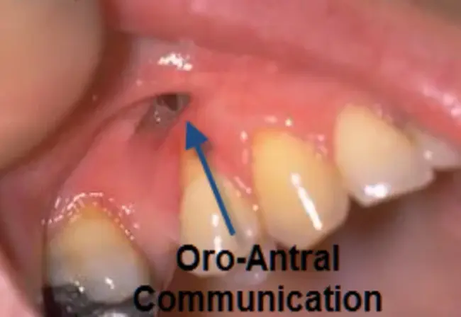 Antral Ethmoidal Sphenoidectomy : 蝶窦筛窦切除术