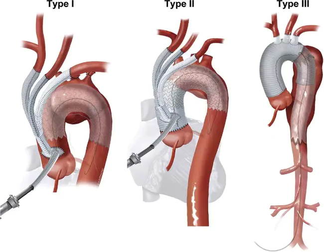 Aortic Arch Atherosclerosis : 主动脉弓动脉粥样硬化