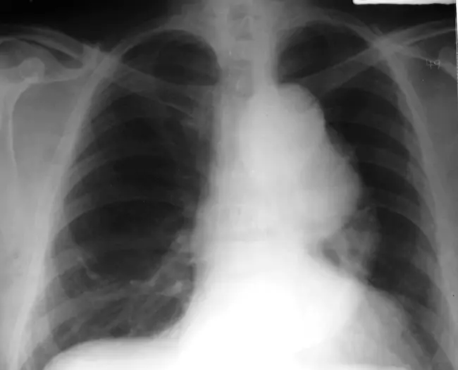 Aortic Compliance : 主动脉顺应性