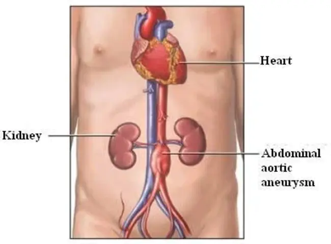 Aortic Incompetence : 主动脉功能不全