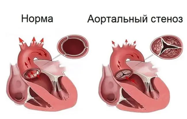 Aortic Occlusion : 主动脉阻塞