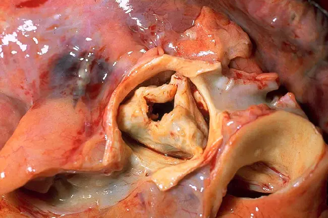 Aortic Valve Echocardiogram : 主动脉瓣超声心动图