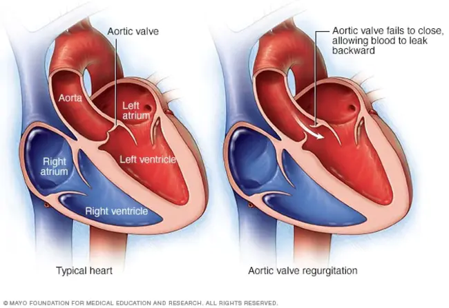 Aortic Valve Gradient : 主动脉瓣梯度