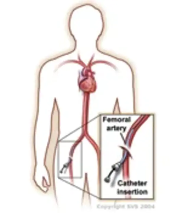 Aorto-Iliac : 主髂动脉