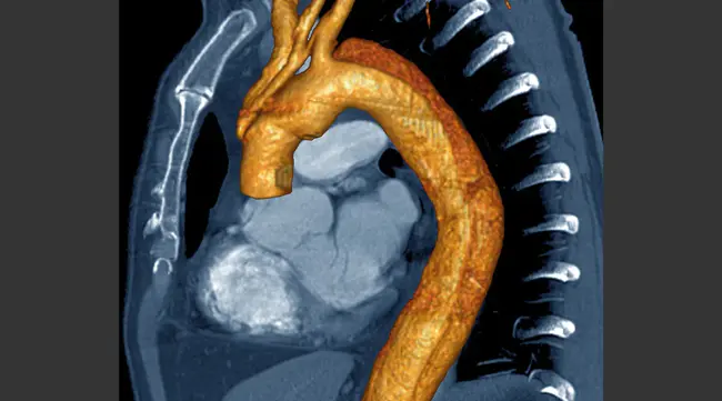 aortocaval shunt : 主动脉腔分流器