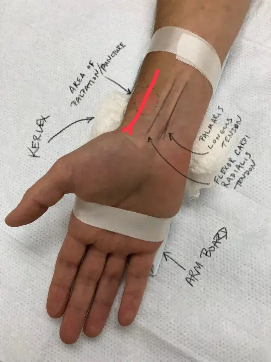 Arterial Line : 动脉线