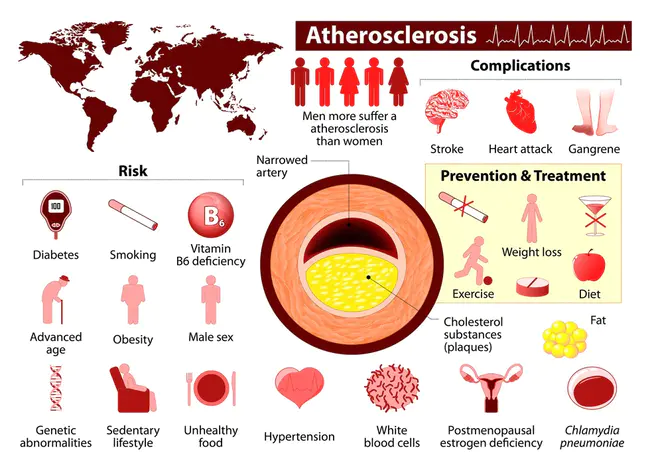 Arteriosclerotic Coronary Disease : 动脉硬化性冠状动脉疾病