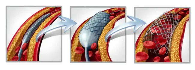 Arterio-Venous Graft : 动静脉移植