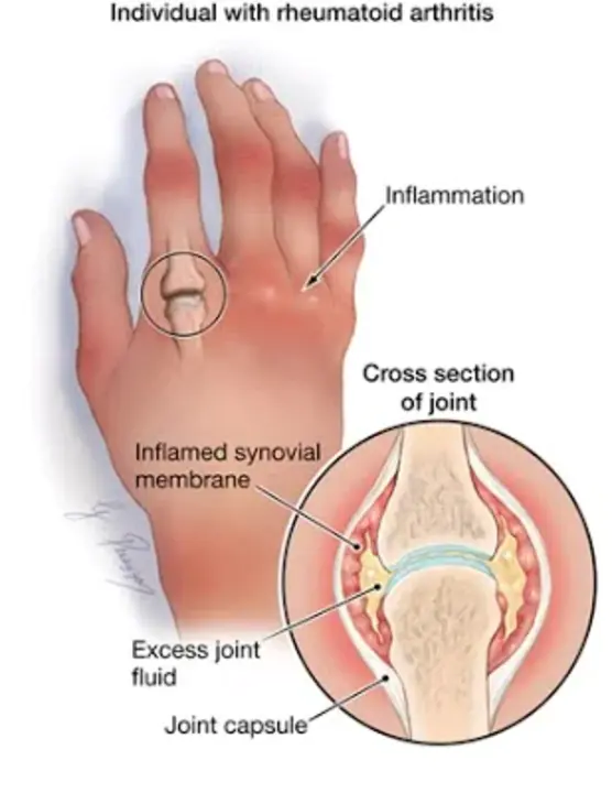 Arthritis Self-Management Course : 关节炎自我管理课程